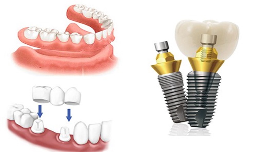 Thắc mắc: Loại Implant nào tốt? Nha khoa cấy ghép implant tốt tại quận 10 ở đâu?