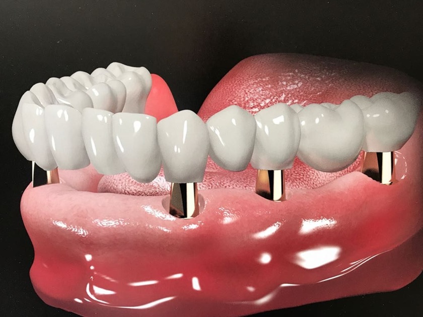 Phương pháp cấy ghép răng implant bằng trụ implant Pháp là một trong những lọai implant tốt hàng đầu hiện nay