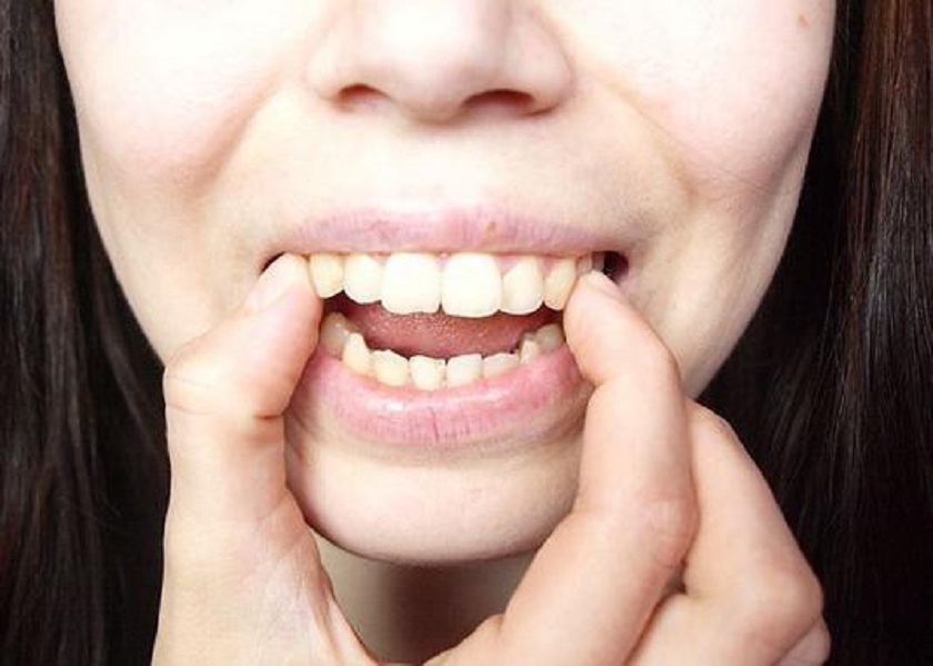 Đối tượng nên bọc răng sứ trị hô